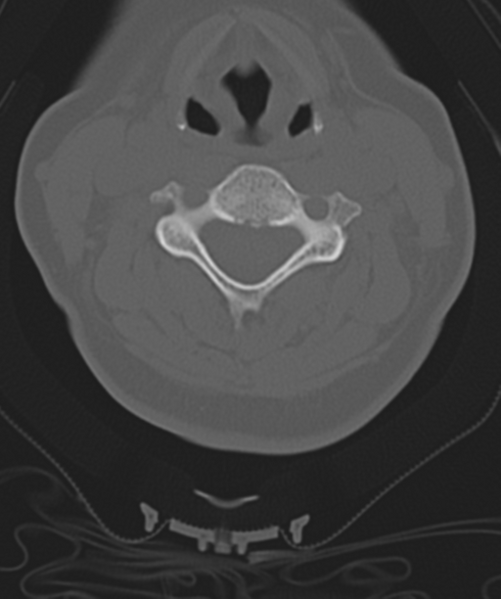 File:Normal cervical spine MRI (including Dixon) (Radiopaedia 42762-45926 Axial bone window 29).png