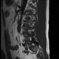 Normal lumbar spine MRI (Radiopaedia 35543-37039 Sagittal T1 2).png