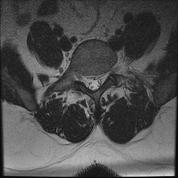 File:Normal lumbar spine MRI (Radiopaedia 43051-46311 Axial T2 21).jpg
