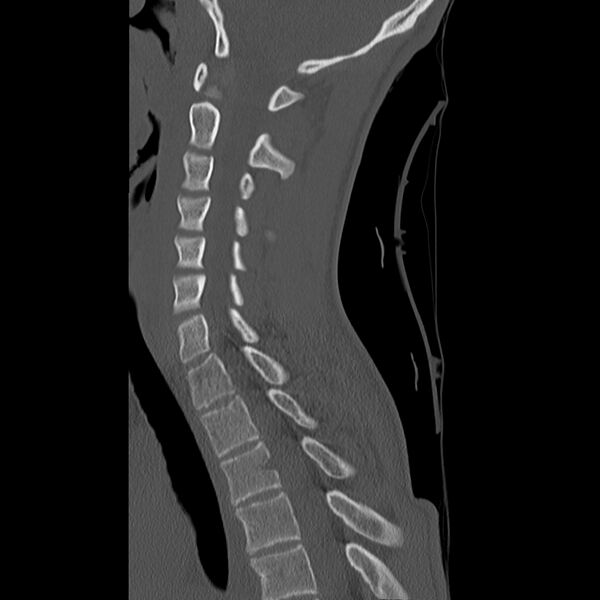 File:Normal trauma spine imaging (age 16) (Radiopaedia 45335-49358 Sagittal bone window 16).jpg
