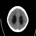 Obstructive hydrocephalus (Radiopaedia 30453-31119 Axial non-contrast 21).jpg