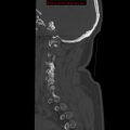 Occipital condyle fracture (Radiopaedia 18366-18208 Sagittal bone window 31).jpg