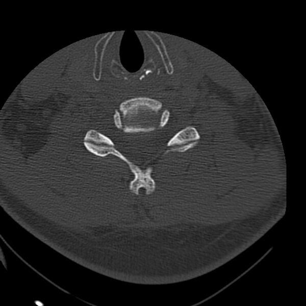File:Occipital condyle fracture (Radiopaedia 31755-32691 Axial bone window 53).jpg