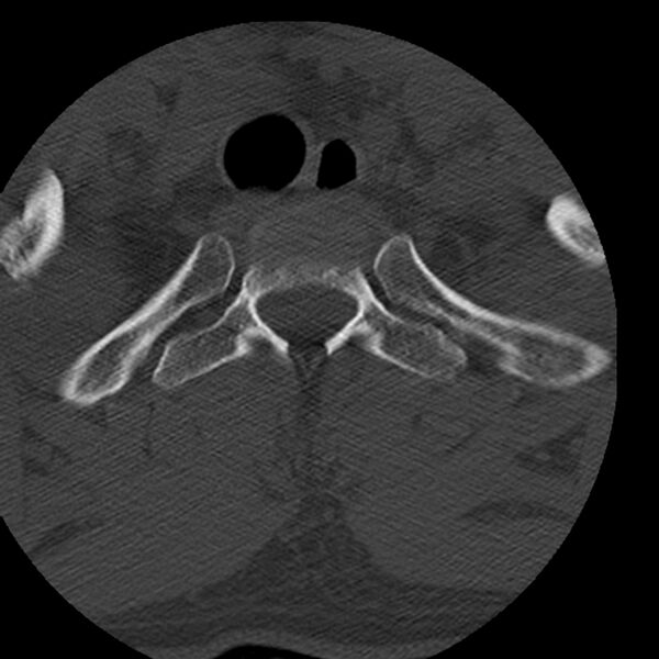 File:Occipital condyle fracture (Radiopaedia 31755-32691 Axial bone window 83).jpg