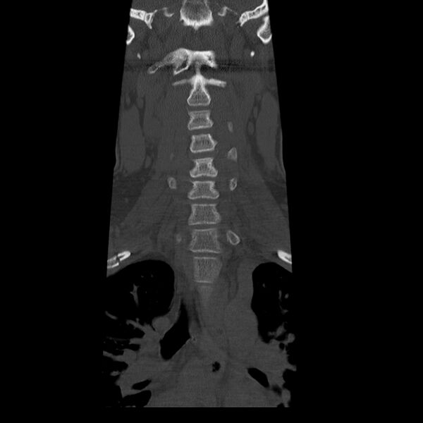 File:Occipital condyle fracture (Radiopaedia 31755-32691 Coronal bone window 8).jpg