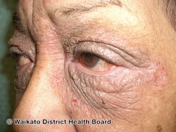 Severe chronic eyelid dermatitis