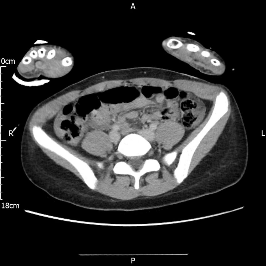 AAST grade IV kidney injury with CEUS follow-up (Radiopaedia 72353-82877 Axial C+ portal venous phase 50).jpg
