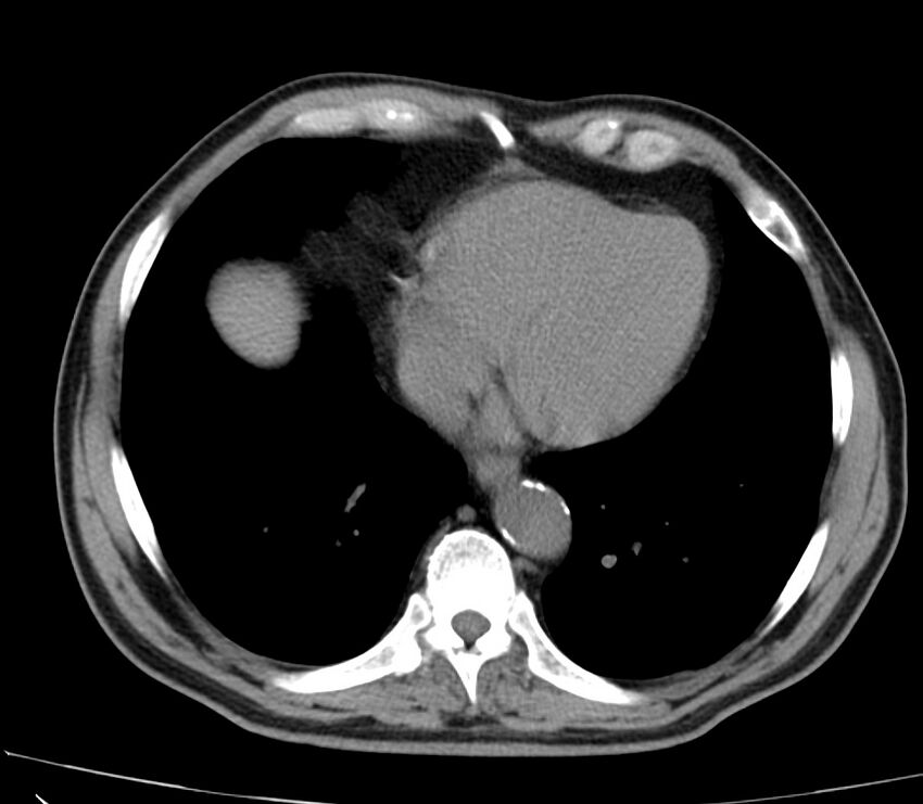 Abdominal aortic aneurysm (Radiopaedia 22421-22458 non-contrast 2).jpg