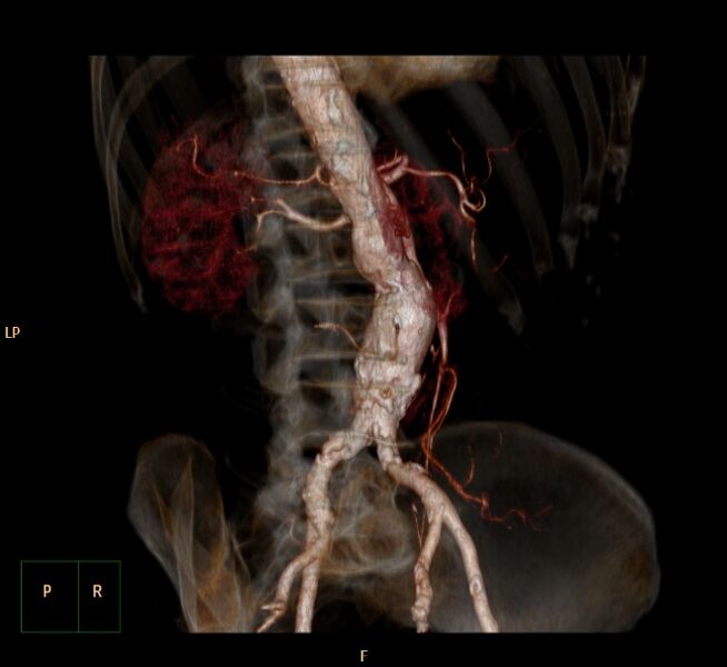 File:Abdominal aortic aneurysm (Radiopaedia 23703-23856 3D 11).jpg
