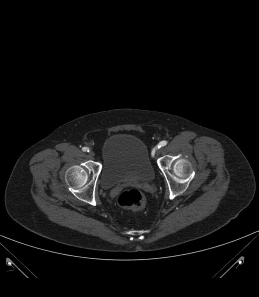 File:Abdominal aortic aneurysm with thrombus fissuration (Radiopaedia 46218-50618 Axial C+ arterial phase 41).jpg