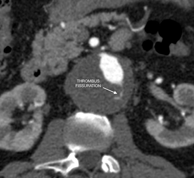File:Abdominal aortic aneurysm with thrombus fissuration (Radiopaedia 46218-50619 Axial 1).png