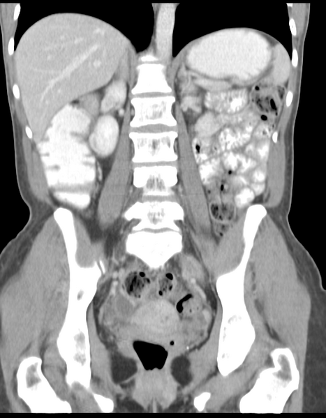 File:Abdominal desmoid tumor (Radiopaedia 41007-43740 Coronal C+ portal venous phase 25).png