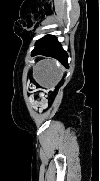 File:Abdominal hydatid disease (Radiopaedia 68223-77737 Sagittal C+ portal venous phase 6).jpg