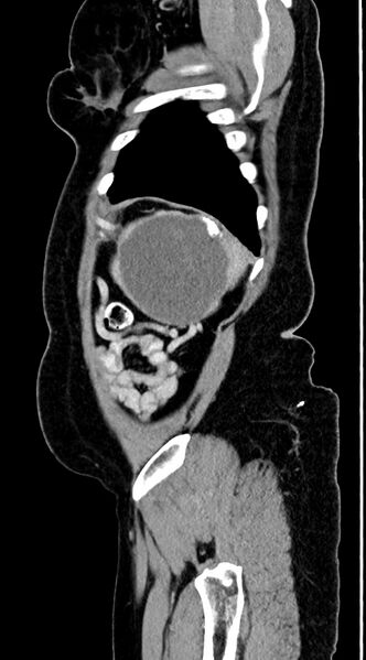 File:Abdominal hydatid disease (Radiopaedia 68223-77737 Sagittal C+ portal venous phase 7).jpg