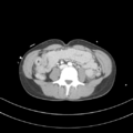 Abdominal multi-trauma - devascularised kidney and liver, spleen and pancreatic lacerations (Radiopaedia 34984-36486 Axial C+ portal venous phase 47).png