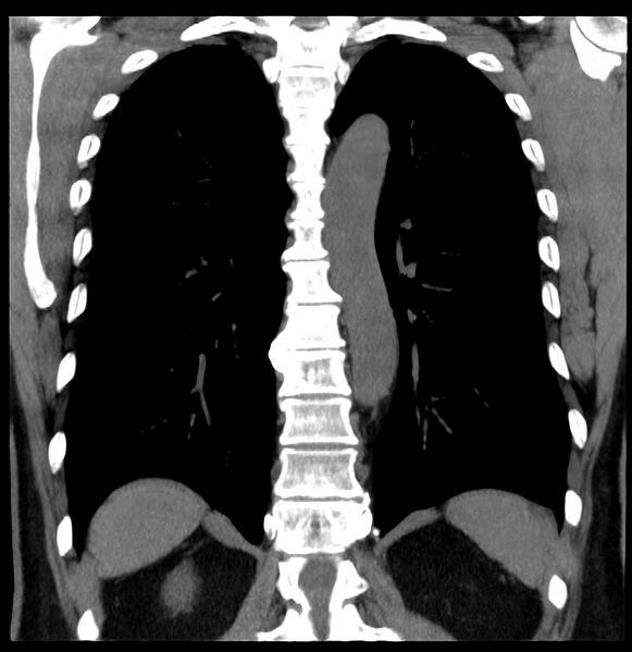 File:Aberrant right subclavian artery (Radiopaedia 40967-43680 Coronal non-contrast 29).jpg