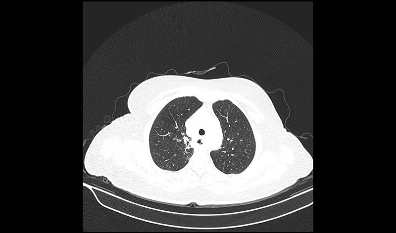 File:Acquired tracheo-esophageal fistula (Radiopaedia 51356-57103 Axial lung window 11).jpg