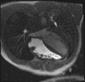 Active right ventricular cardiac sarcoidosis (Radiopaedia 55596-62100 Axial Dynamic perfusion scan MOCO 59).jpg