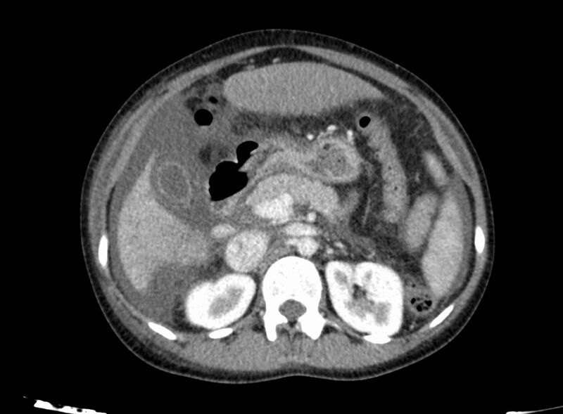 File:Acute Budd-Chiari syndrome (Radiopaedia 60858-68638 Axial C+ portal venous phase 112).jpg