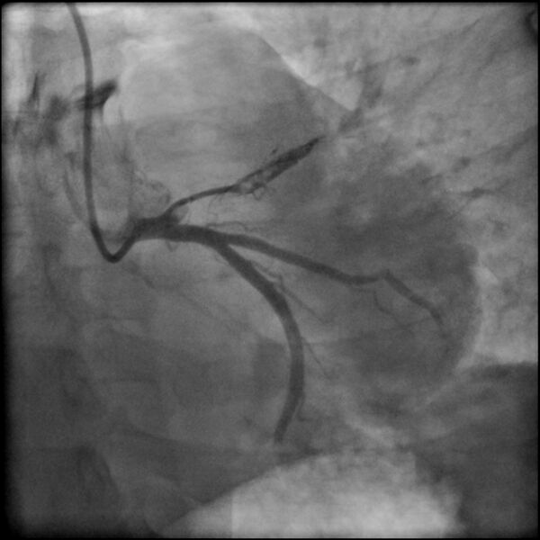 File:Acute anteroseptal myocardial infarction (Radiopaedia 68409-77946 LAO caudal (spider view) LAD and CX 19).jpg
