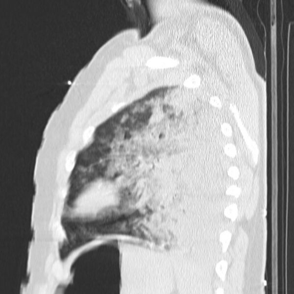 File:Acute aspiration pneumonitis (Radiopaedia 33605-34703 Sagittal lung window 68).jpg