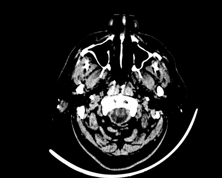 File:Acute cerebral infarct (Radiopaedia 35604-37123 Axial non-contrast 2).jpg