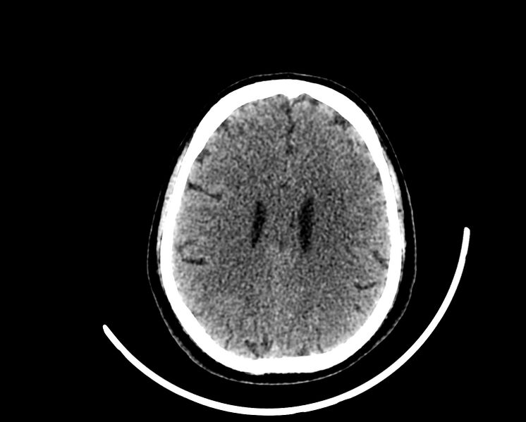 File:Acute cerebral infarct (Radiopaedia 35604-37123 Axial non-contrast 69).jpg
