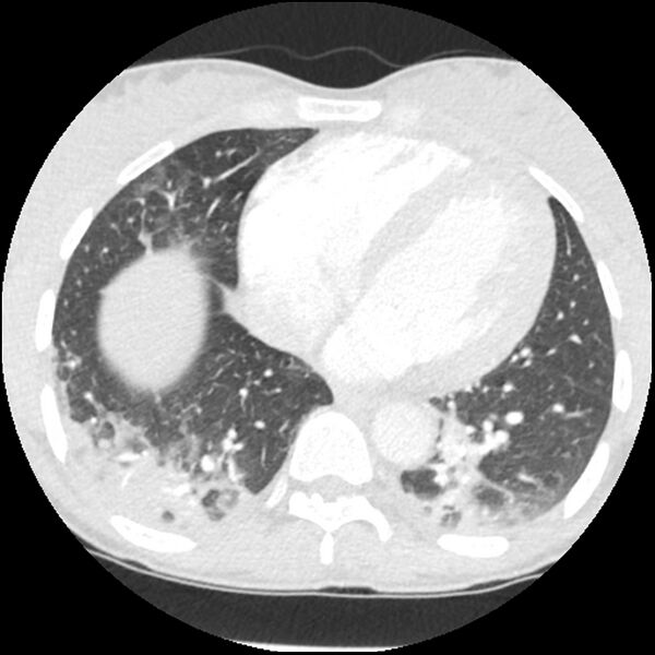 File:Acute chest syndrome - sickle cell disease (Radiopaedia 42375-45499 Axial lung window 135).jpg