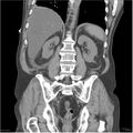 Acute pancreatitis (Radiopaedia 19135-19116 Coronal non-contrast 33).jpg