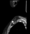 Acute parotitis (Radiopaedia 27425-27619 Sagittal C+ portal venous phase 54).png