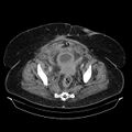 Acute pyelonephritis (Radiopaedia 25657-25837 Axial renal parenchymal phase 68).jpg