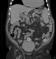 Acute renal failure post IV contrast injection- CT findings (Radiopaedia 47815-52557 Coronal non-contrast 16).jpg