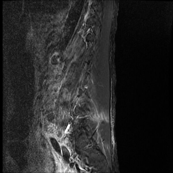 File:Acute vertebral body compression fractures (Radiopaedia 31757-32694 Sagittal STIR 2).jpg