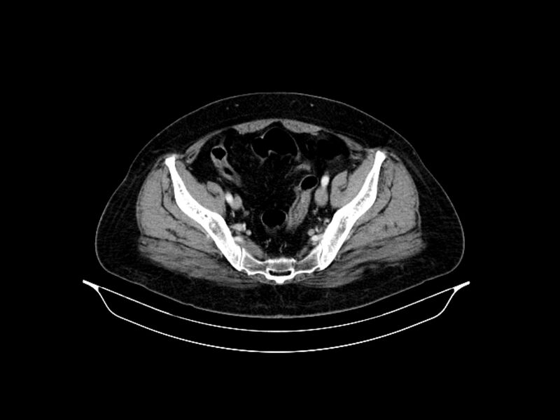 File:Adenocarcinoma of pancreas with hepatic metastasis (Radiopaedia 64332-73122 Axial C+ portal venous phase 85).jpg