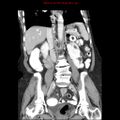 Adenocarcinoma of the colon (Radiopaedia 8191-9039 Coronal liver window 27).jpg
