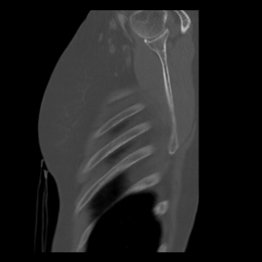 Adenocarcinoma of the lung (Radiopaedia 41015-43755 Sagittal bone window 104).jpg