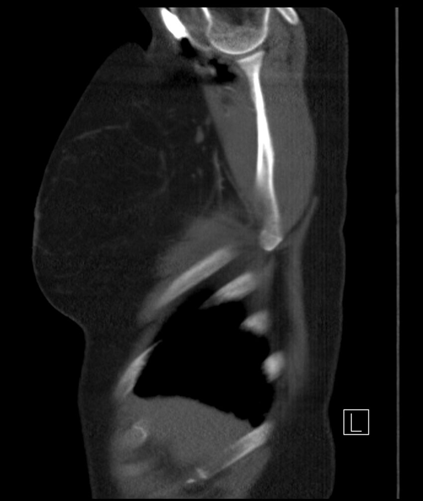 Adenocarcinoma of the lung (Radiopaedia 44205-47803 Sagittal C+ portal venous phase 53).jpg