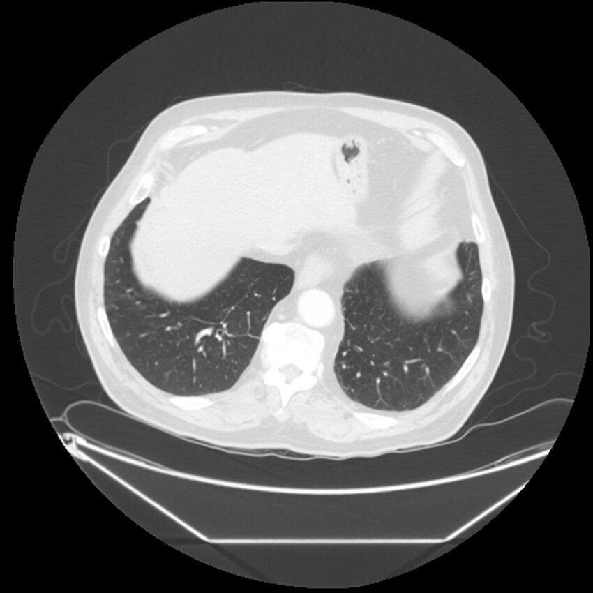 Adenocarcinoma of the lung (Radiopaedia 44876-48759 Axial lung window 65).jpg