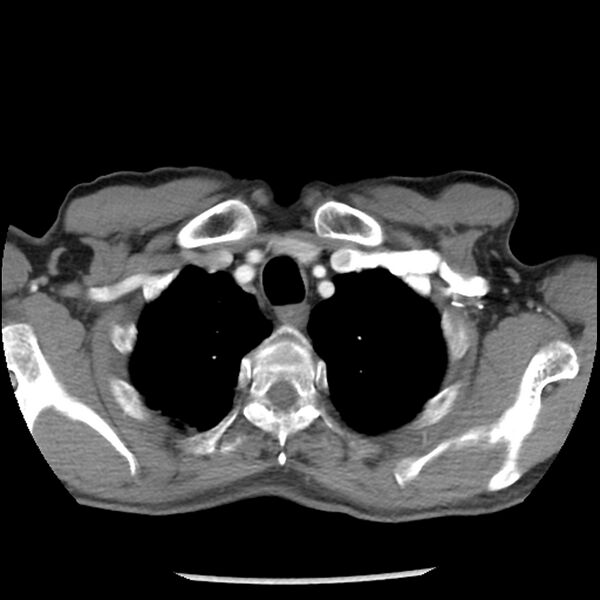 File:Adenocarcinoma of the lung - micropapillary predominant (Radiopaedia 42446-45563 Axial C+ portal venous phase 9).jpg