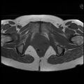 Adenoma malignum of the cervix (Radiopaedia 24460-24765 T1 17).jpg