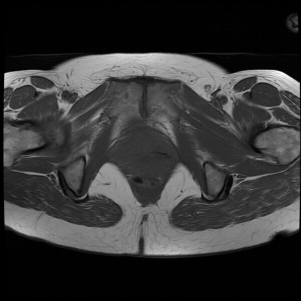 File:Adenoma malignum of the cervix (Radiopaedia 24460-24765 T1 17).jpg