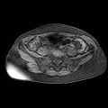 Adenomyoma of the uterus (huge) (Radiopaedia 9870-10438 Axial T1 fat sat 26).jpg
