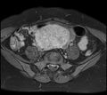 Adenomyosis - ovarian endometriomas (Radiopaedia 67031-76350 Axial T1 C+ fat sat 6).jpg