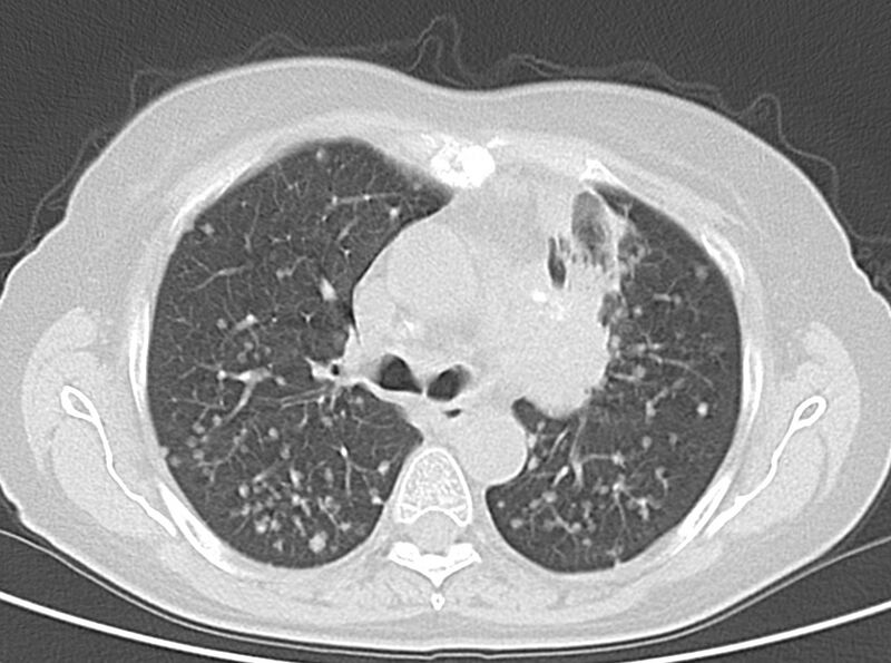 File:Adenosquamous lung carcinoma (Radiopaedia 22035-22030 lung window 27).jpg