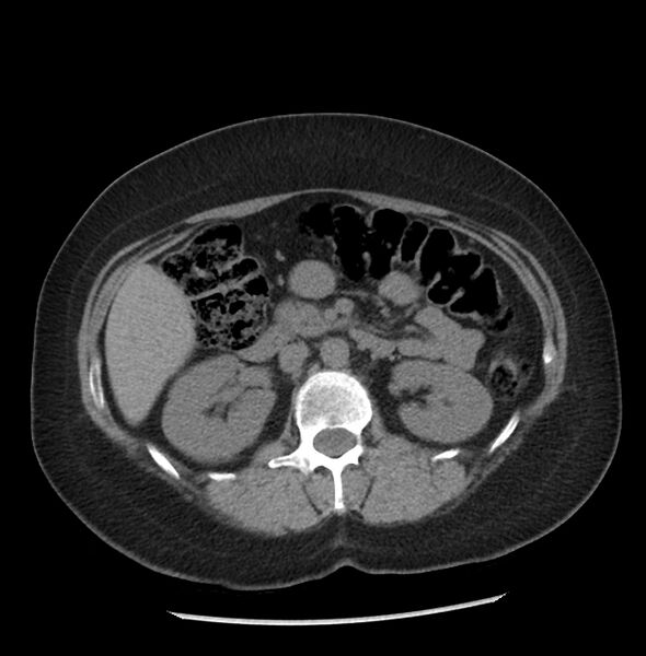 File:Adrenal cortical carcinoma with IVC invasion and thrombosis (Radiopaedia 34307-35597 Axial non-contrast 24).jpg