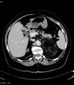 Adrenal myelolipoma (Radiopaedia 6765-7960 Axial C+ arterial phase 9).jpg