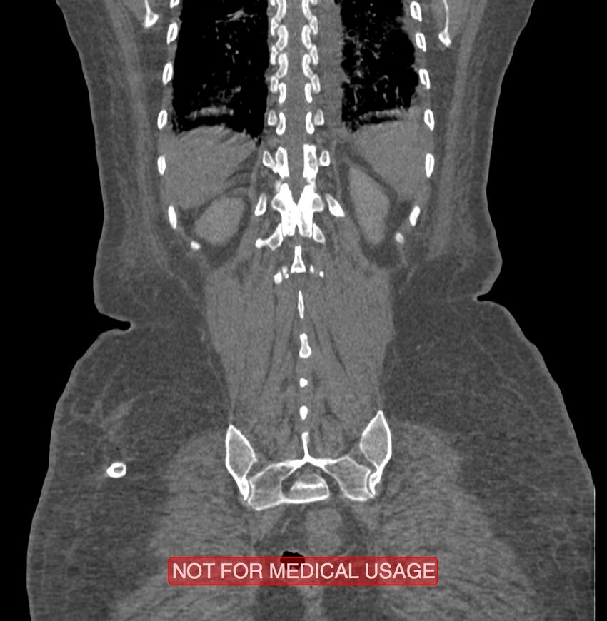 Amoebic enterocolitis with liver abscess (Radiopaedia 35100-36609 B 176).jpg