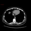 Ampullary carcinoma (Radiopaedia 56396-63056 Axial non-contrast 6).jpg