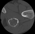 Aneurysmal bone cyst of ischium (Radiopaedia 25957-26094 B 34).png