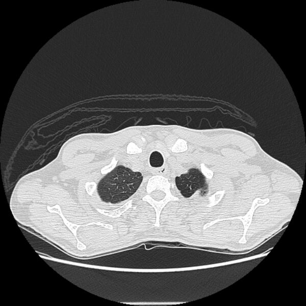 File:Angioinvasive aspergellosis (Radiopaedia 66995-76315 Axial lung window 2).jpg